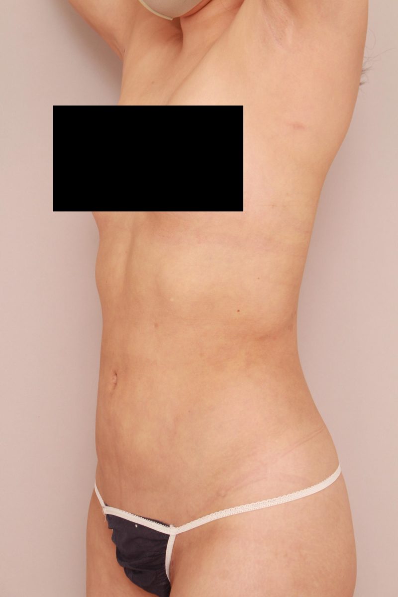 お腹、腰の脂肪吸引1か月後