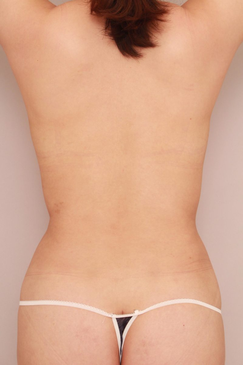 腰の脂肪吸引モニター様1か月後