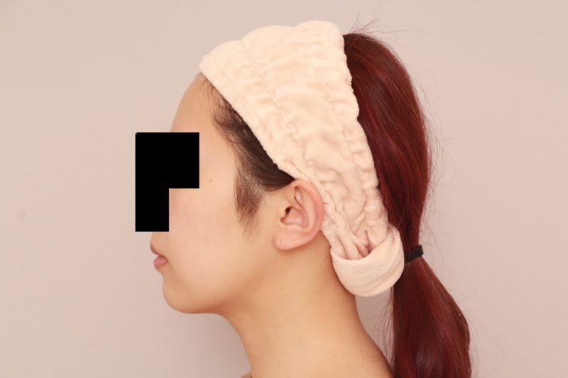 痩せている方のほほ顎脂肪吸引3か月後