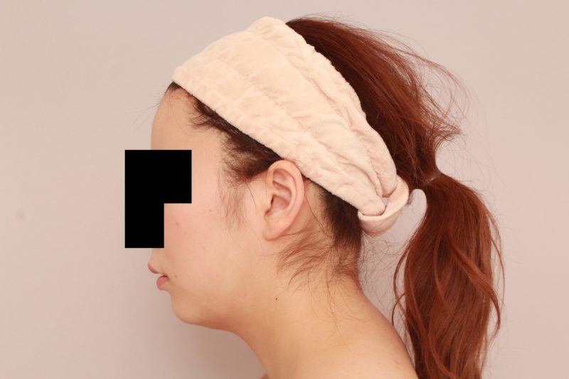 ほほ顎脂肪吸引モニター様1か月後