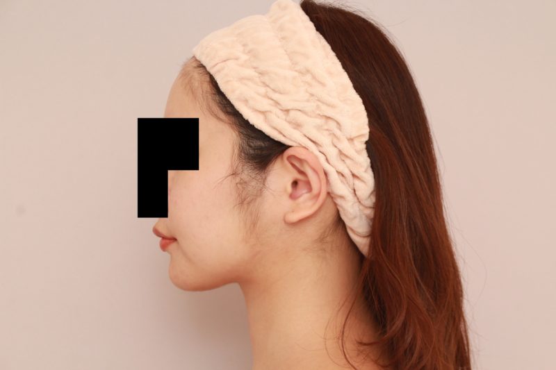 ほほ顎脂肪吸引1か月後