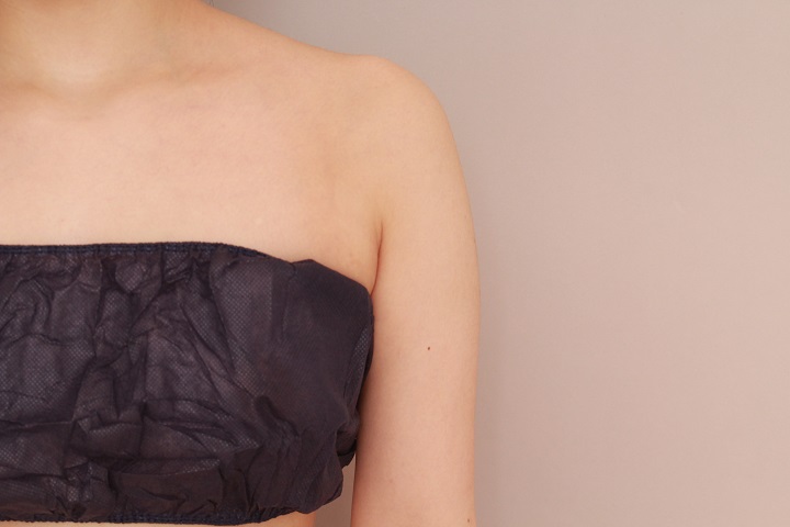 二の腕・肩の脂肪吸引 術後6カ月の経過