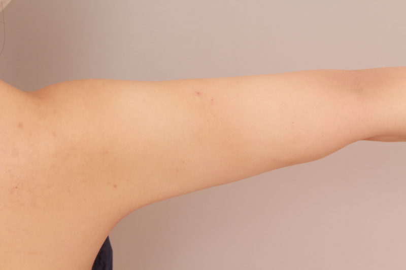 二の腕、肩の脂肪吸引3か月後