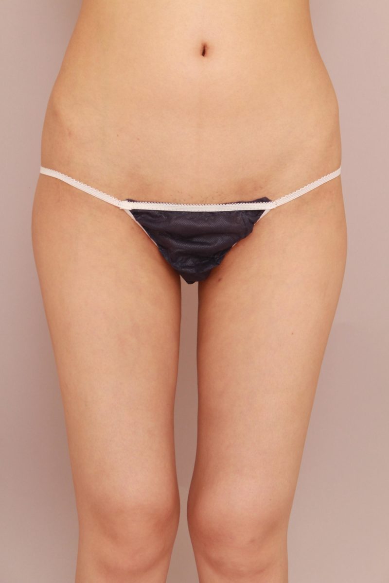 太もも全周、お尻の脂肪吸引のモニター様1か月後