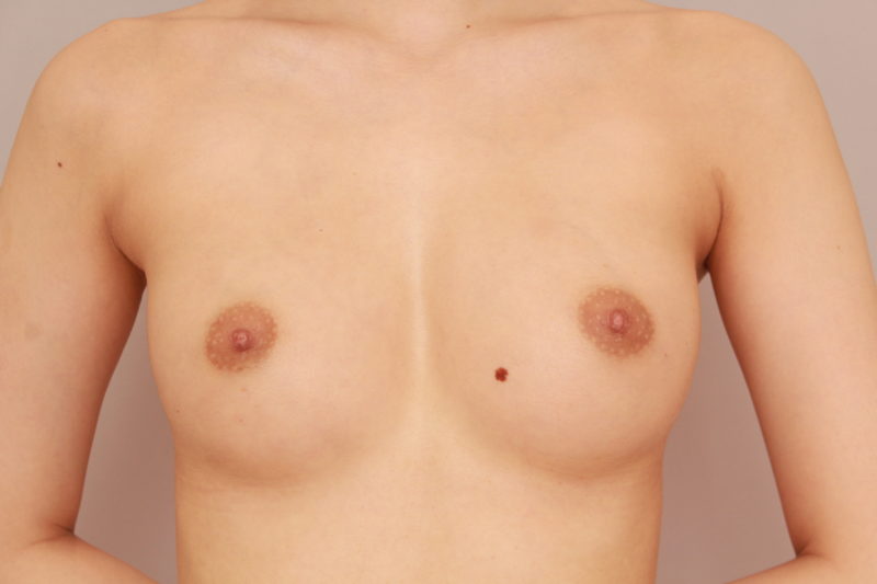 コンデンスリッチ豊胸モニター様1か月後