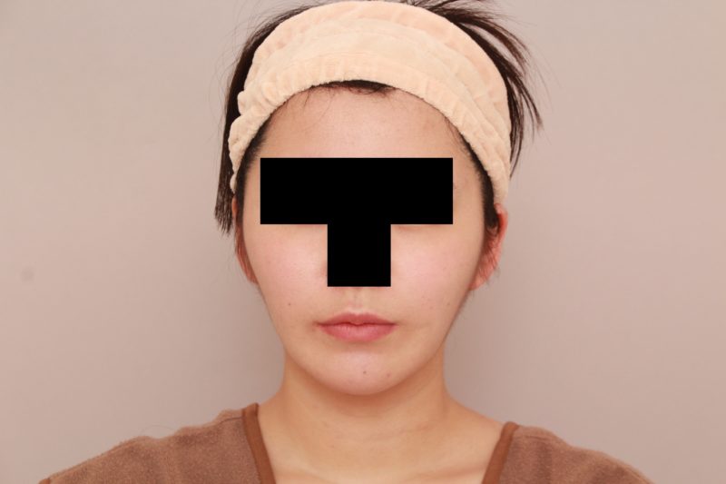 ほほ顎脂肪吸引3か月後