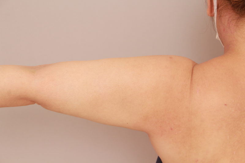 二の腕、肩の脂肪吸引3か月後