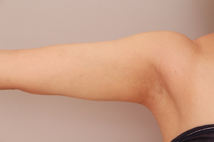 二の腕・肩の脂肪吸引 術後3ヵ月の経過