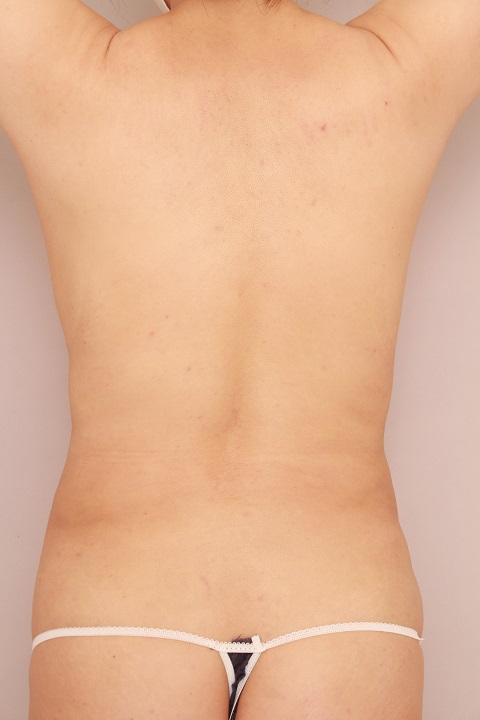 お腹・腰の脂肪吸引 術後1ヵ月の経過