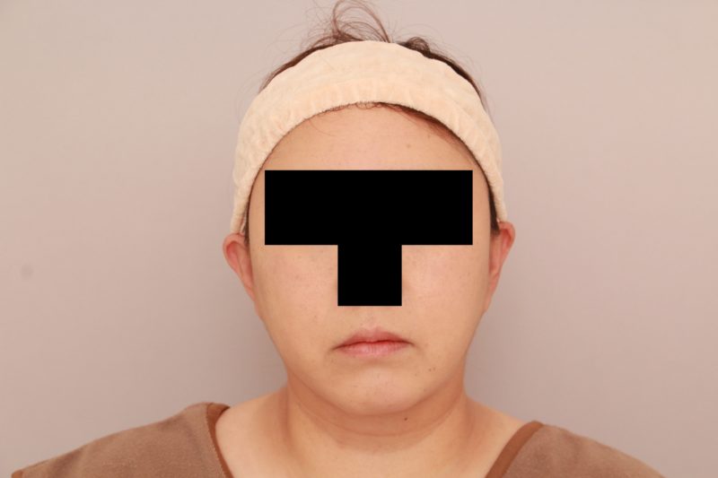 ほほ顎脂肪吸引3か月後