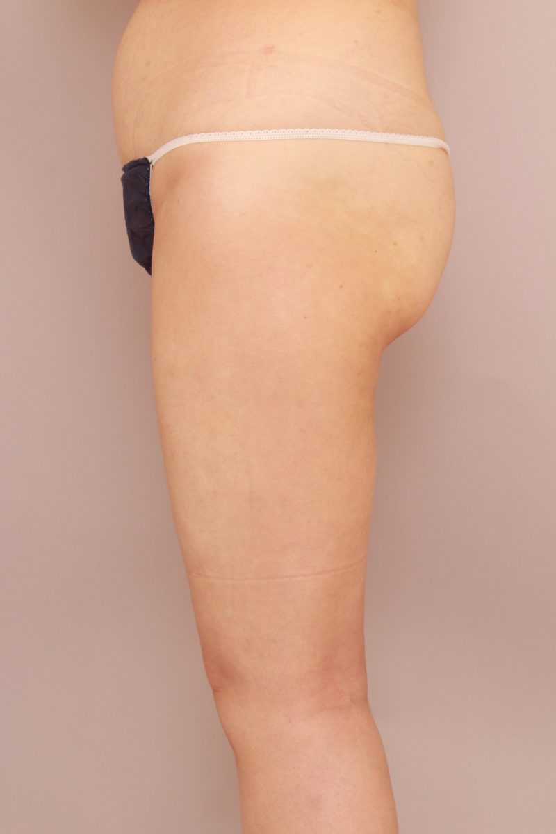 太もも全周、お尻の脂肪吸引1か月後