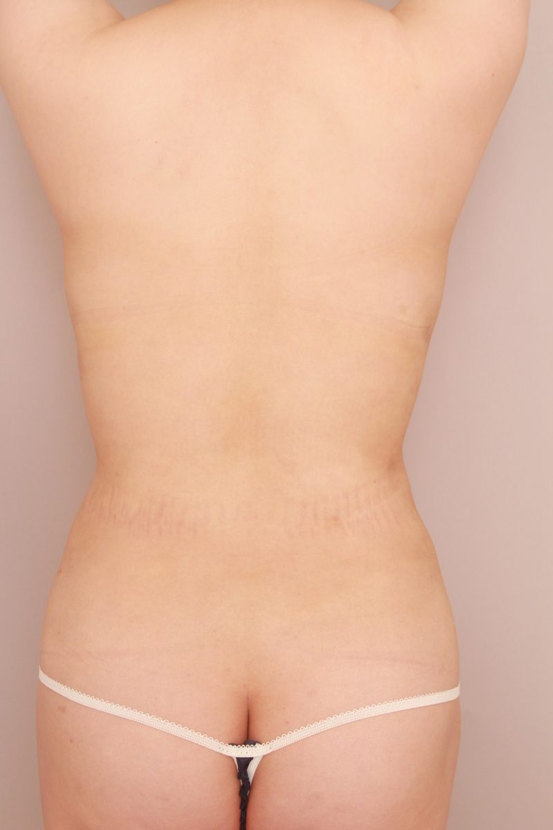 お腹、腰の脂肪吸引1か月後