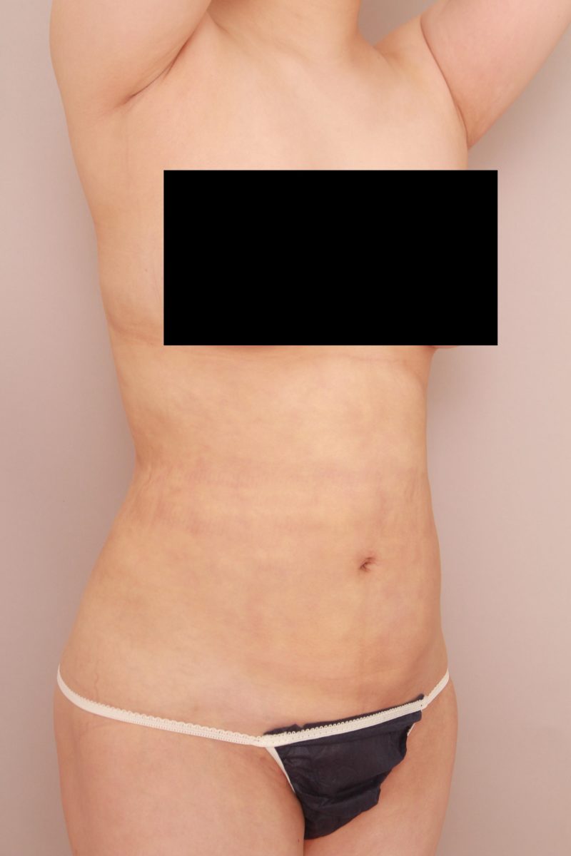 お腹全体、胸下のモニター様1か月後