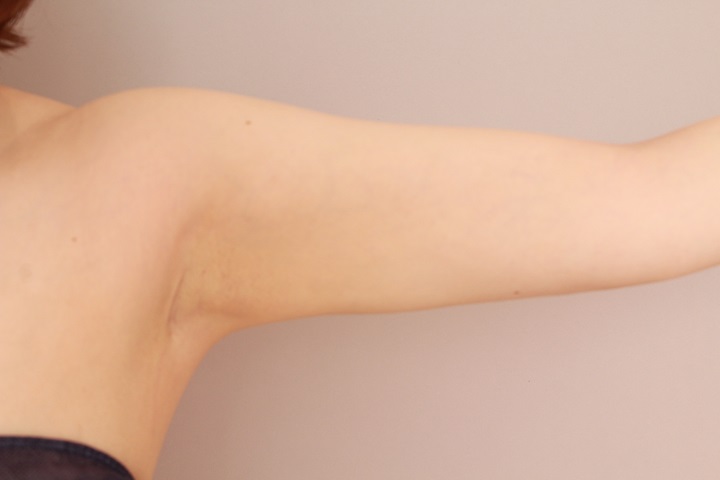 二の腕・肩の脂肪吸引 術後6ヵ月の経過
