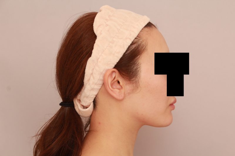 ほほ顎脂肪吸引のモニター様6か月後