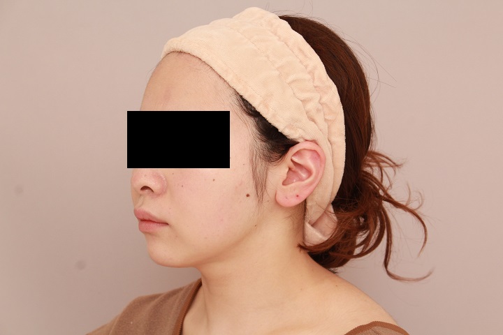 お顔の脂肪吸引 術後3カ月の経過