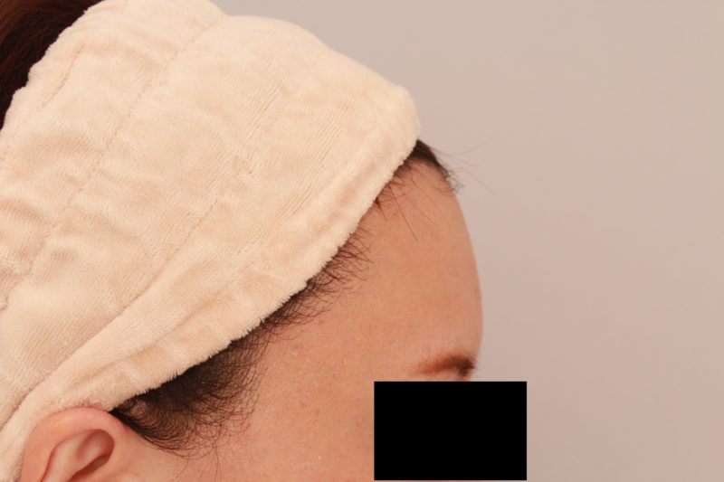 オデコ、こめかみの脂肪注入5か月後