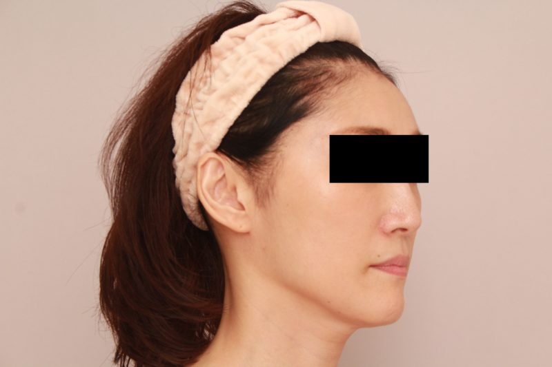 マイルドな変化ご希望のエイジングケアモニター様1か月後