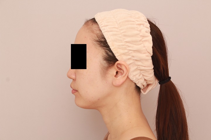 お顔の脂肪吸引 術後6カ月の経過