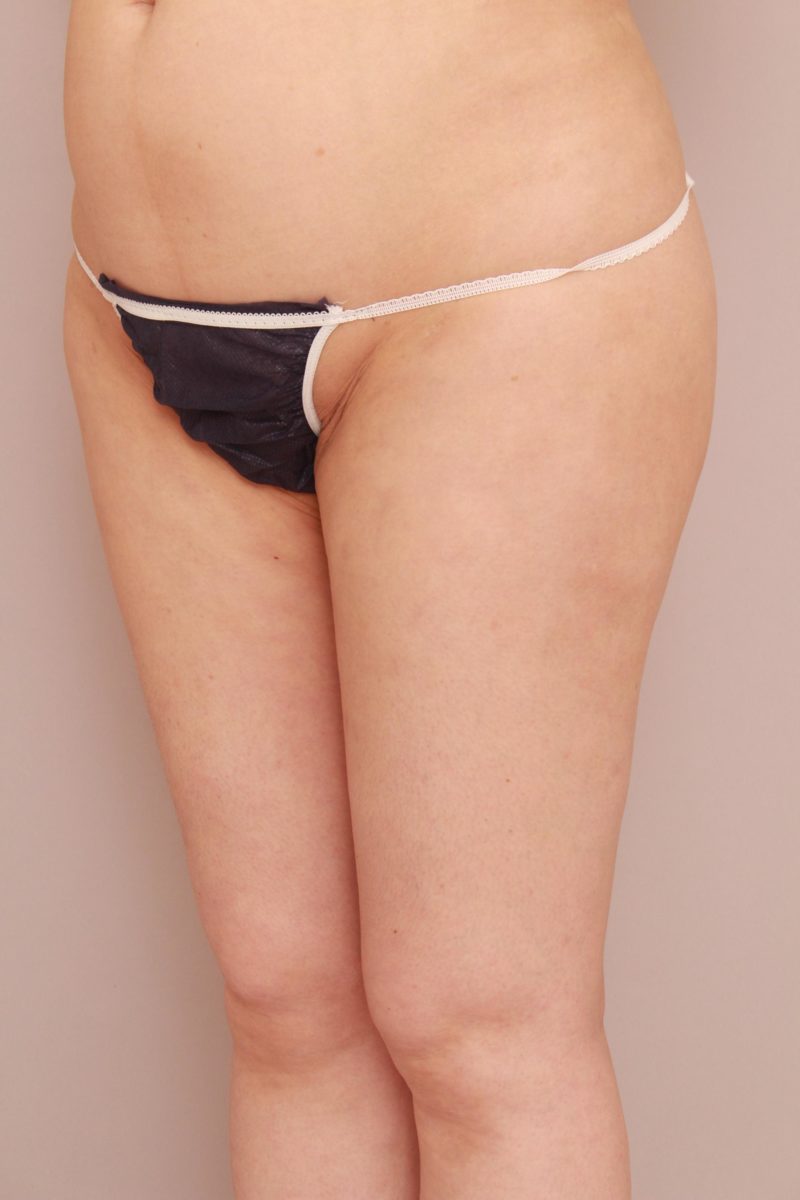 太ももの脂肪吸引他院修正