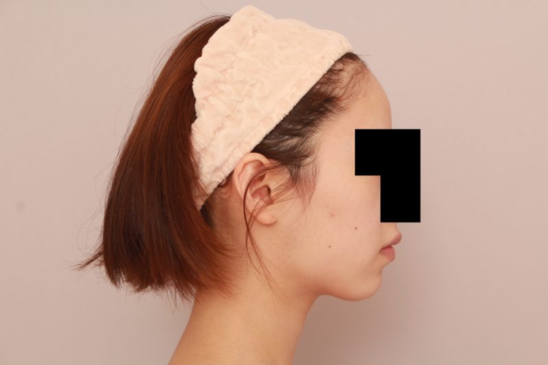 もともと痩せている方のほほ顎脂肪吸引