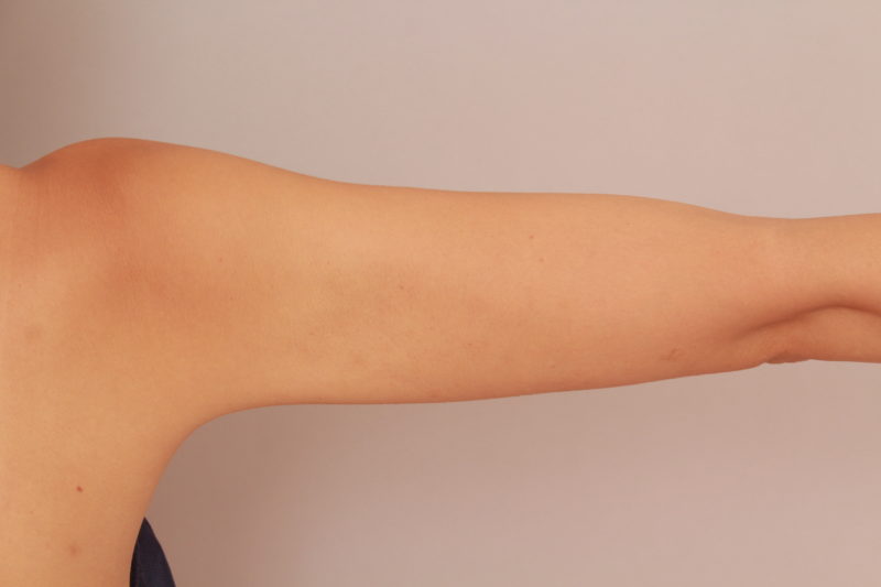 もともと細い方の二の腕、肩の脂肪吸引3か月後