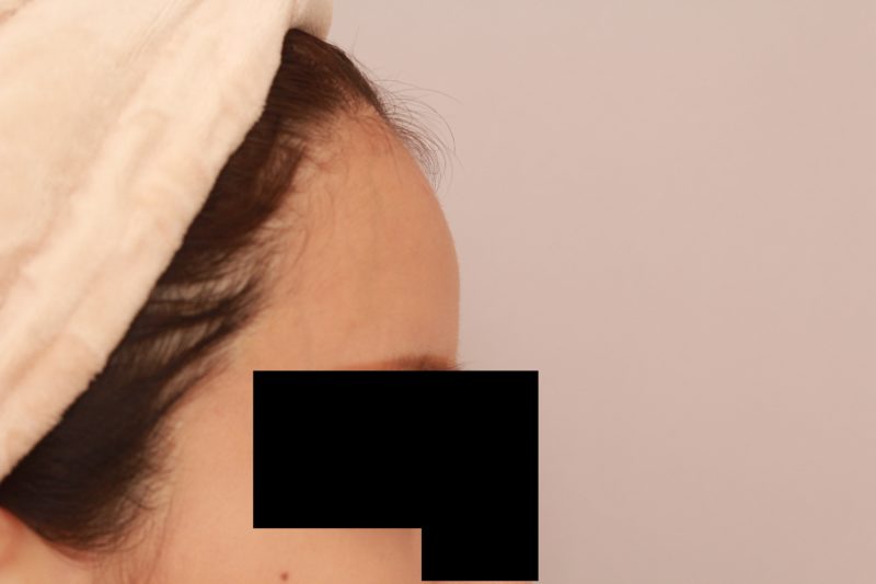 おでここめかみの脂肪注入3か月後