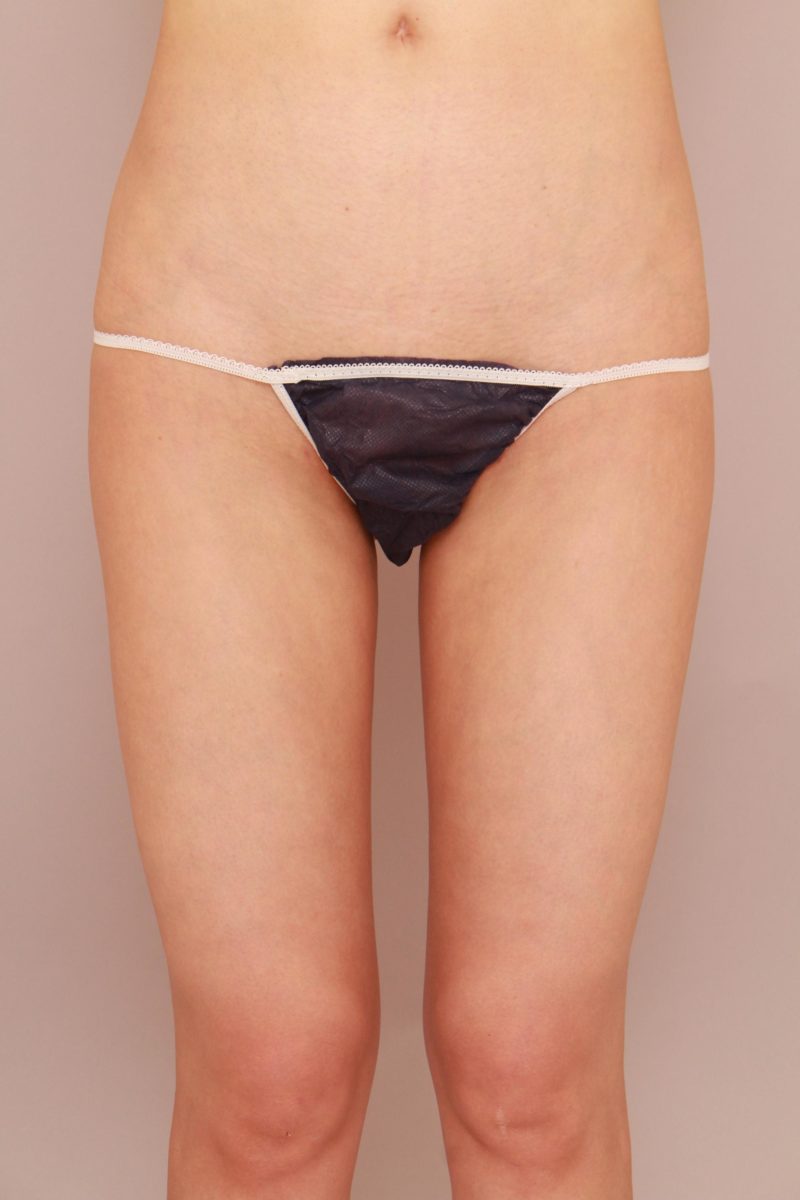 もともと痩せている方の太もも全周、お尻の脂肪吸引3か月後