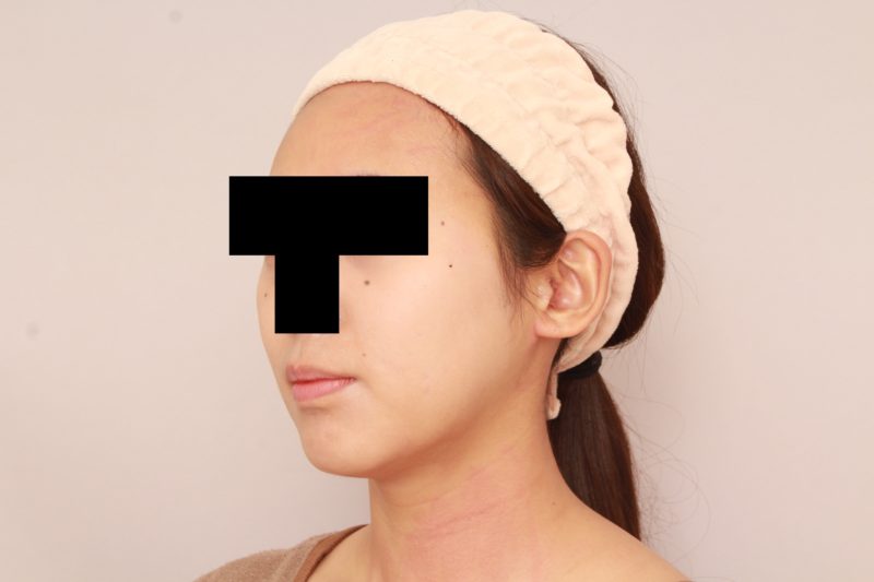 ほほ顎脂肪吸引1か月後のモニター様