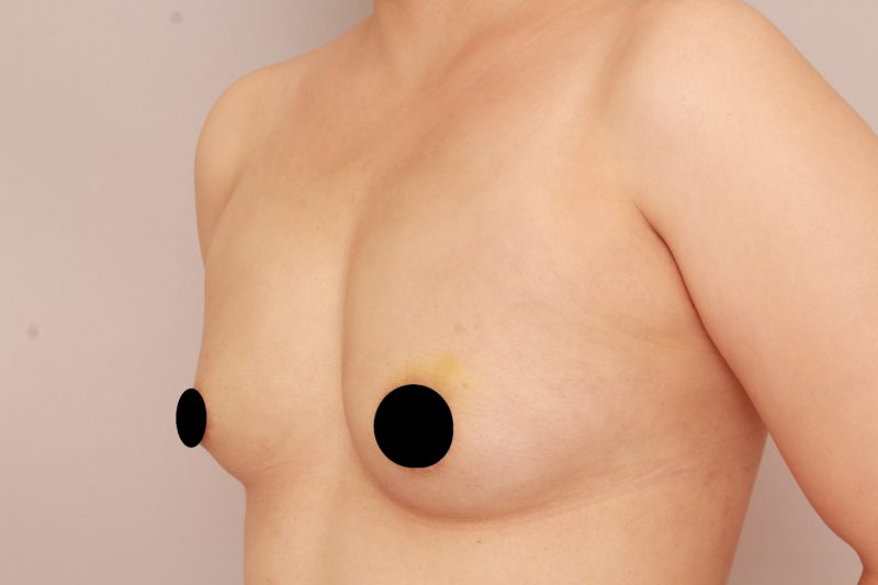 アクアフィリング除去後の脂肪注入豊胸モニター様1か月後