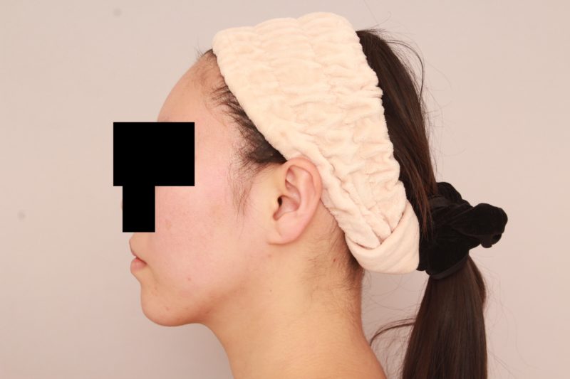 ほほ顎脂肪吸引のモニター様3か月後