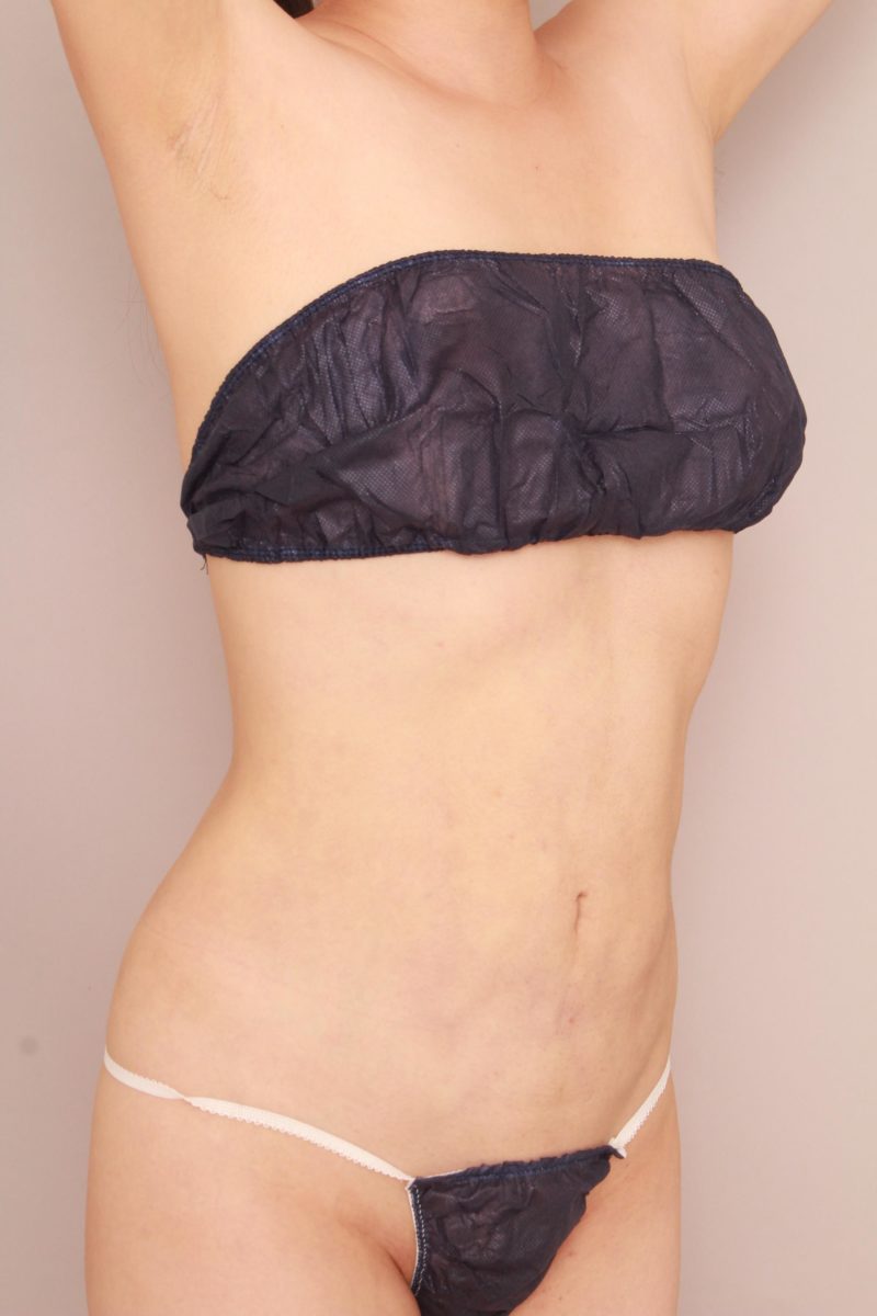 お腹、腰の脂肪吸引3か月後