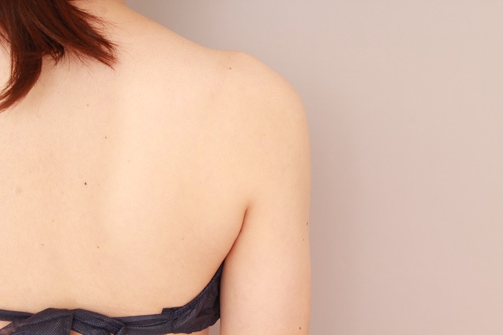 二の腕・肩の脂肪吸引 術後3カ月の経過