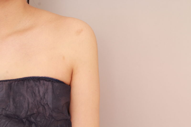 二の腕、肩の脂肪吸引3か月後