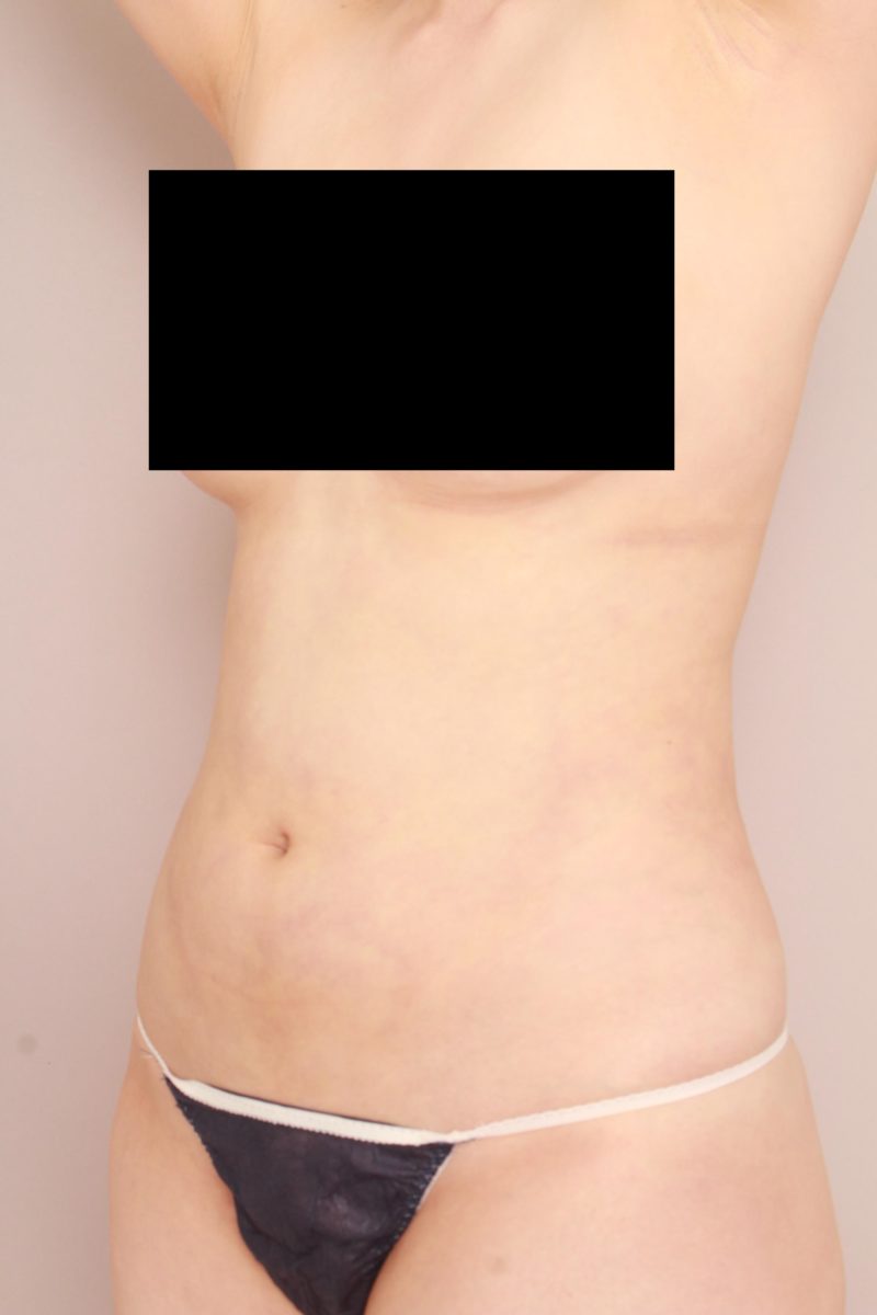 お腹、腰の脂肪吸引1か月後