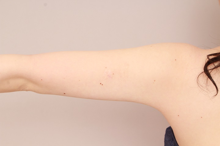 二の腕・肩の脂肪吸引 術後3カ月の経過