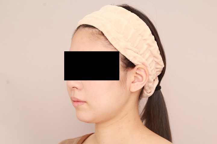 お顔の脂肪吸引 術後1ヵ月の経過