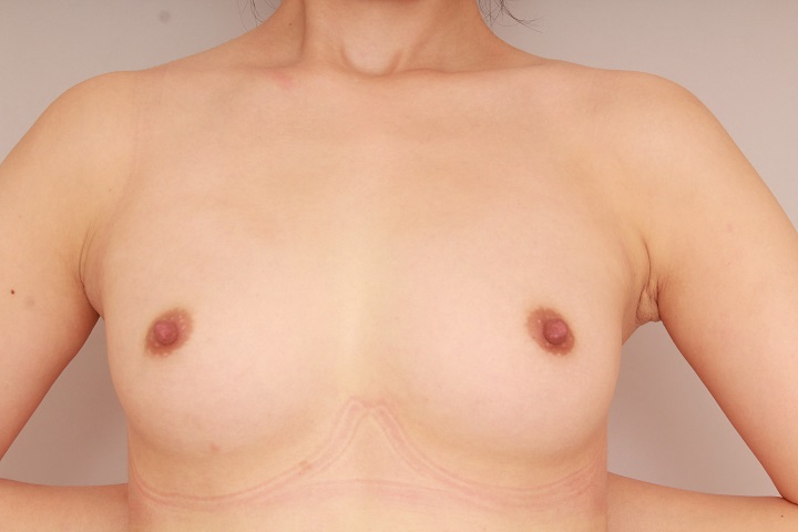 コンデンスリッチ豊胸 術後3カ月の経過