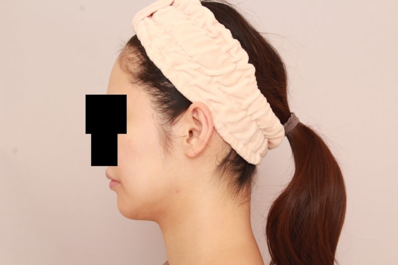 ほほ顎脂肪吸引3か月後の変化