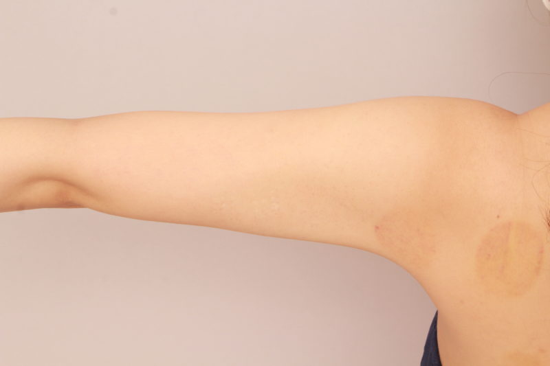 二の腕、肩の脂肪吸引6か月後