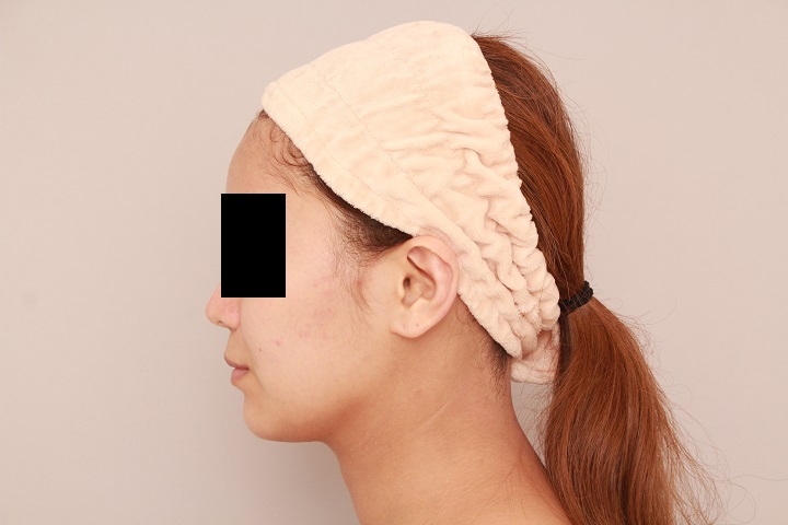 お顔の脂肪吸引 術後3カ月の経過