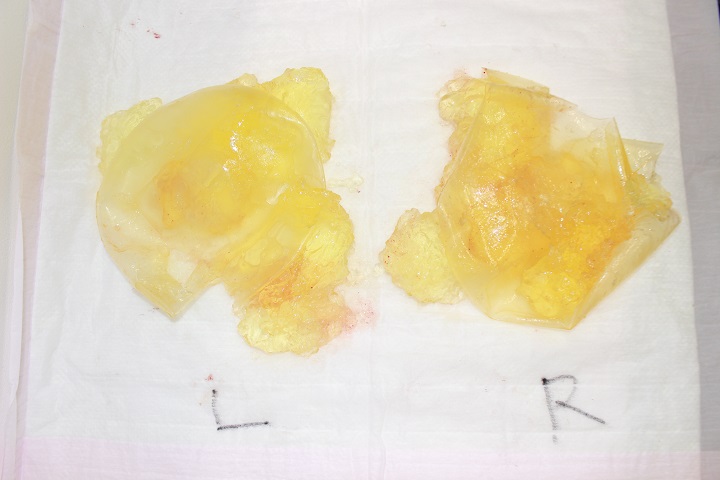 抜去したシリコンバッグ