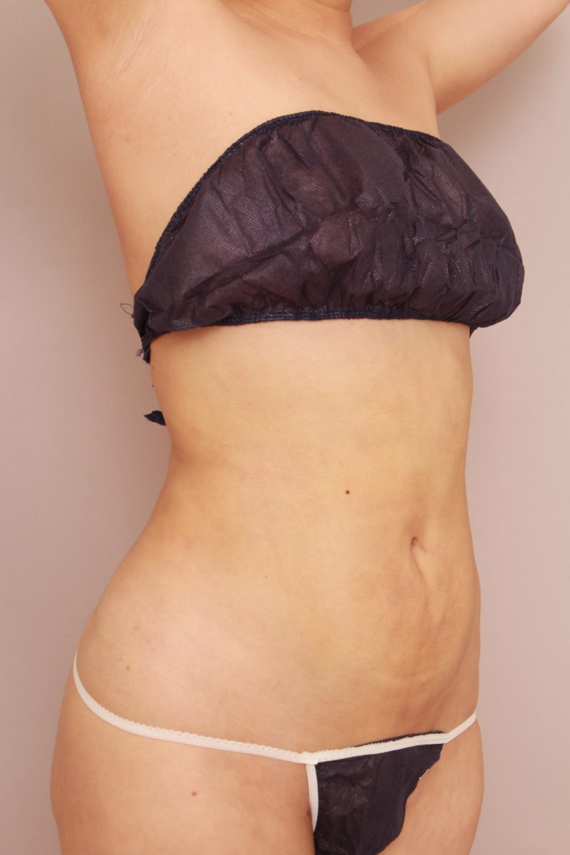 お腹全体、胸下、腰の脂肪吸引25日後の変化