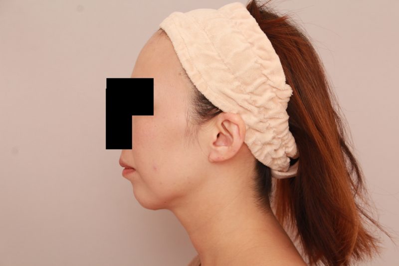 ほほ顎脂肪吸引3か月後