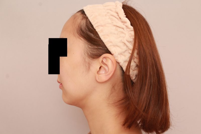 お顔の下半身のラインを整えてまっすます美人顔に♡