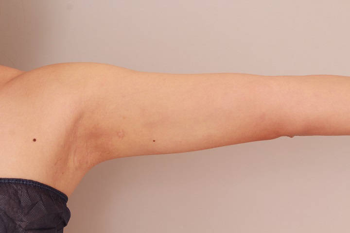 二の腕・肩の脂肪吸引 術後6カ月の経過