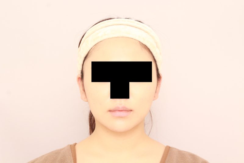 ほほ顎脂肪吸引モニター様半年後
