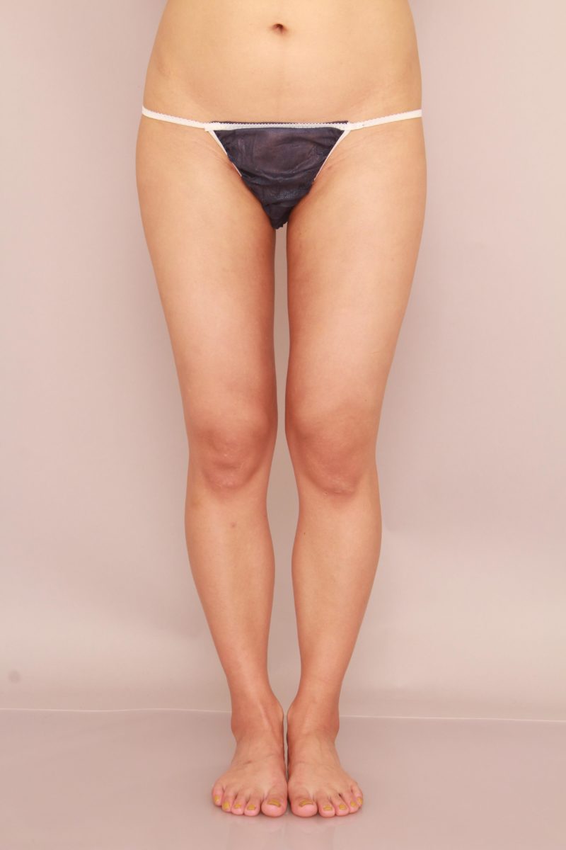 太もも全周、お尻の脂肪吸引モニター様1か月後