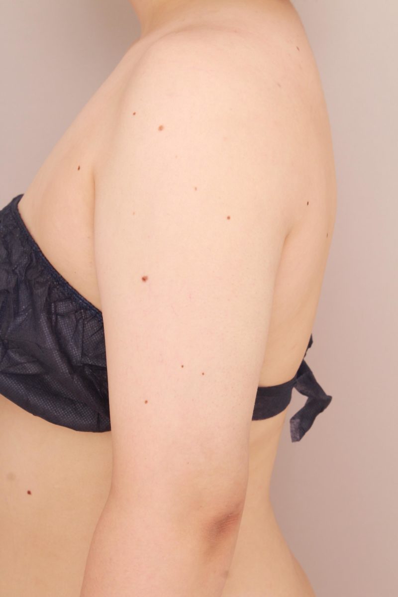 二の腕、肩の脂肪吸引1か月後