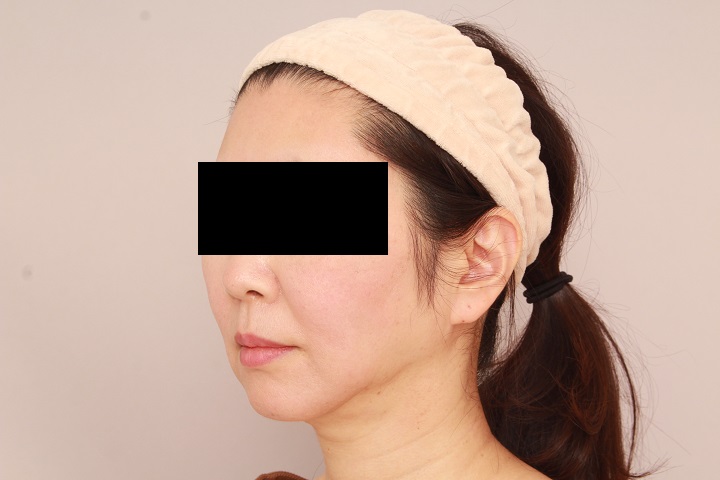 お顔の脂肪吸引 術後3ヵ月の経過